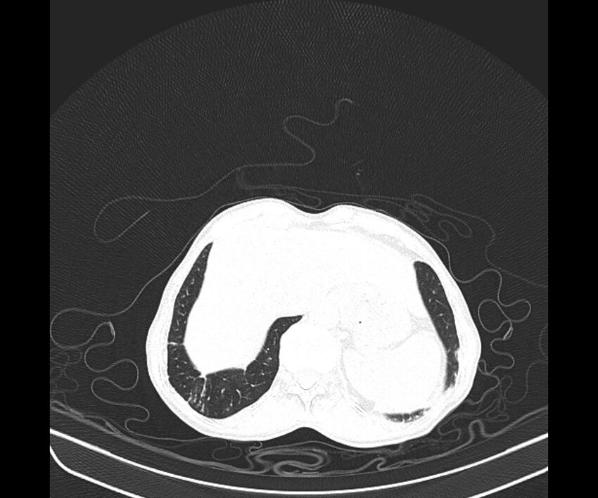 Aspergillomas (Radiopaedia 66779-76110 Axial lung window 44).jpg