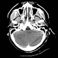 Atlanto-occipital dislocation (Radiopaedia 44648-48412 Axial non-contrast 13).jpg