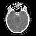 Atlanto-occipital dislocation (Radiopaedia 44648-48412 Axial non-contrast 20).jpg