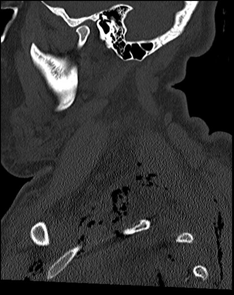 File:Atlanto-occipital dissociation - Traynelis type 1 (Radiopaedia 87570-103948 Sagittal bone window 22).jpg