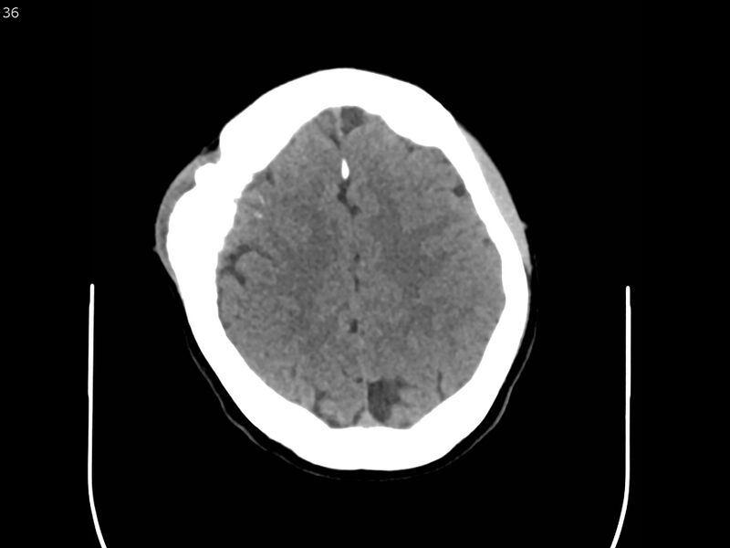 File:Atypical meningioma - intraosseous (Radiopaedia 64915-73867 A 36).jpg