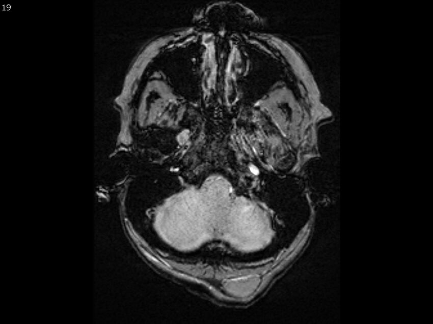 Atypical meningioma - intraosseous (Radiopaedia 64915-74572 Axial SWI 19).jpg