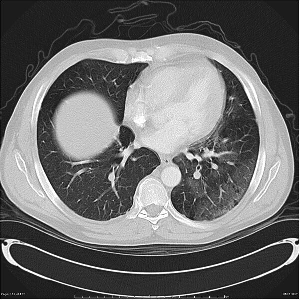 File:Atypical pneumonia - Q fever (Radiopaedia 21993-21989 lung window 29).jpg