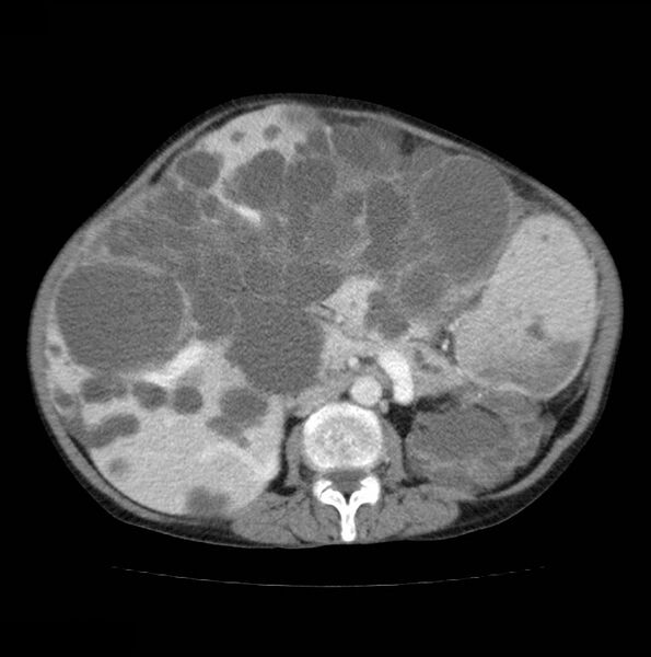 File:Autosomal dominant polycystic kidney disease (Radiopaedia 16777-16490 A 27).jpg