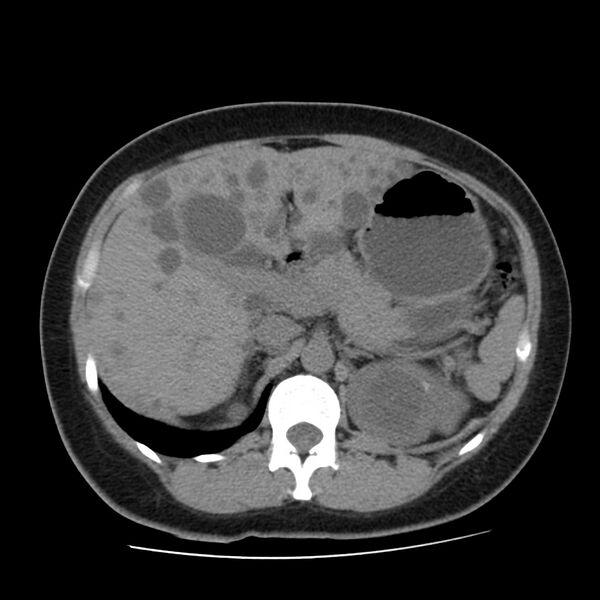 File:Autosomal dominant polycystic kidney disease (Radiopaedia 23061-23093 Axial non-contrast 18).jpg