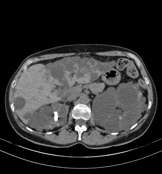 File:Autosomal dominant polycystic kidney disease (Radiopaedia 41918-44922 Axial non-contrast 9).jpg