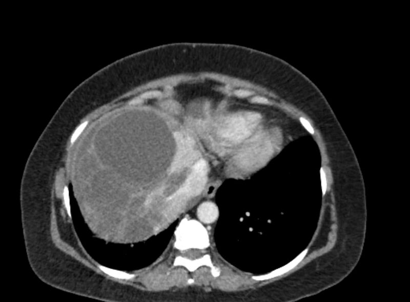 File:Autosomal dominant polycystic kidney disease (Radiopaedia 57124-64017 A 19).jpg