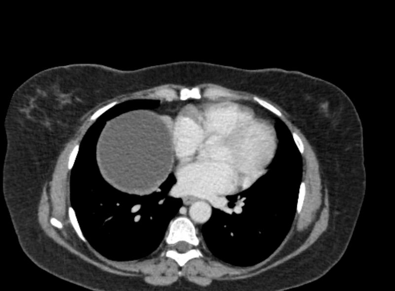 File:Autosomal dominant polycystic kidney disease (Radiopaedia 57124-64017 A 7).jpg