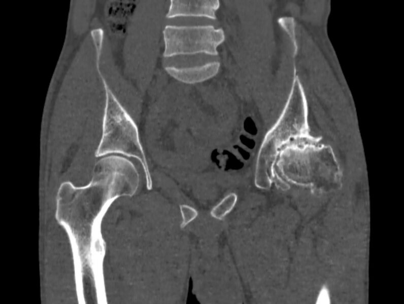 File:Avascular necrosis of the left hip (Radiopaedia 75068-86125 Coronal bone window 26).jpg