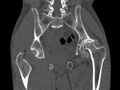 Avascular necrosis of the left hip (Radiopaedia 75068-86125 Coronal bone window 51).jpg