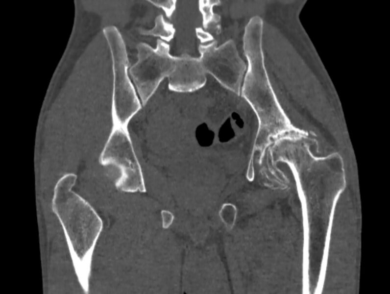 File:Avascular necrosis of the left hip (Radiopaedia 75068-86125 Coronal bone window 51).jpg