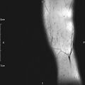 Avulsion fracture of the fibular head (Radiopaedia 74804-85808 D 1).jpg