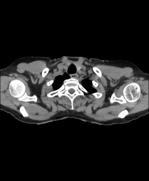 File:Azygos fissure and azygos lobe (Radiopaedia 41841-44832 Axial non-contrast 13).jpg
