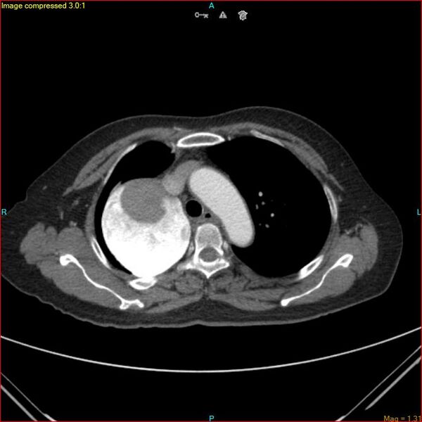 File:Azygos vein aneurysm (Radiopaedia 77824-90130 B 19).jpg