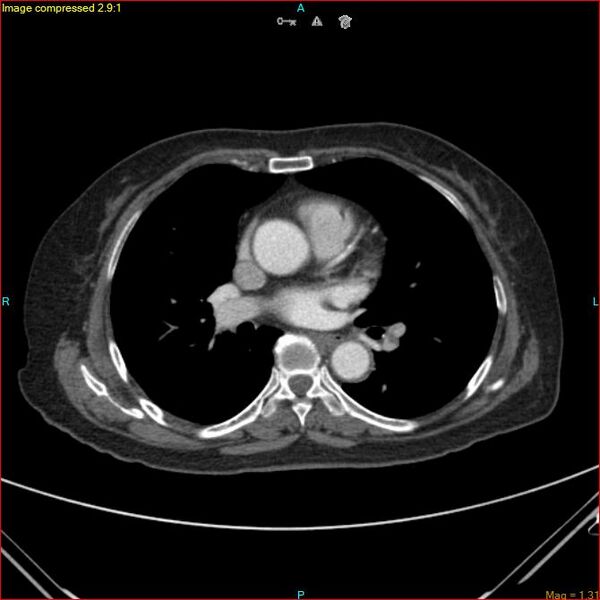 File:Azygos vein aneurysm (Radiopaedia 77824-90130 B 31).jpg