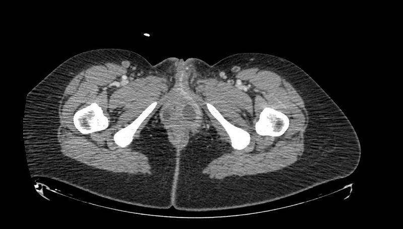 File:Bartholin gland abscess (Radiopaedia 11231-11596 Axial 1).jpg