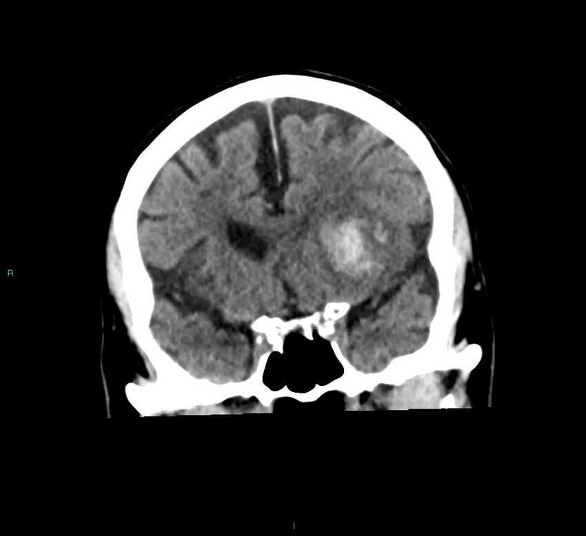 Basal ganglia hemorrhage (Radiopaedia 58791-66025 Coronal non-contrast 41).jpg