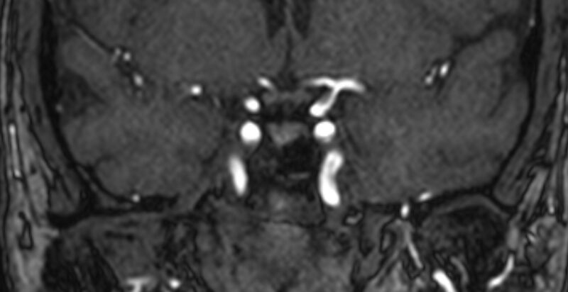 File:Basilar artery fenestration (Radiopaedia 74537-85455 Coronal MRA TOF 13).jpg
