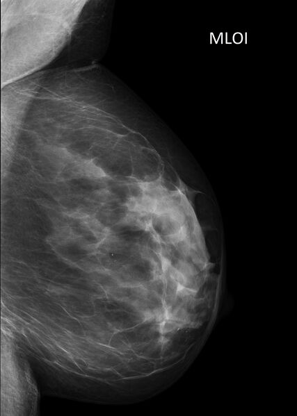 File:Benign breast clustered microcalcifications (Radiopaedia 84548-99945 D 1).jpg