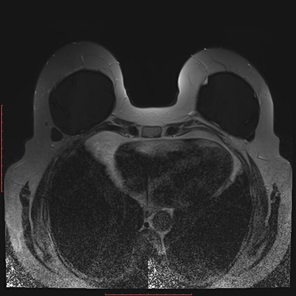 File:Bilateral breast implant rupture (Radiopaedia 24761-25027 T2 fat sat 26).jpg