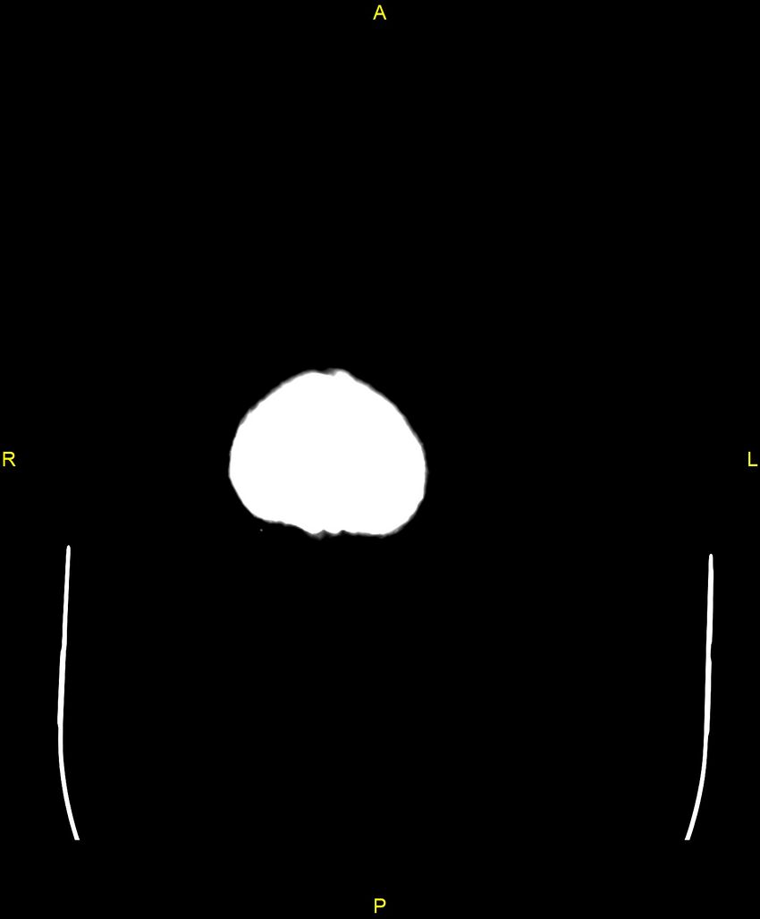 Bilateral isodense subdural hematomas (Radiopaedia 88621-105325 Axial non-contrast 112).jpg