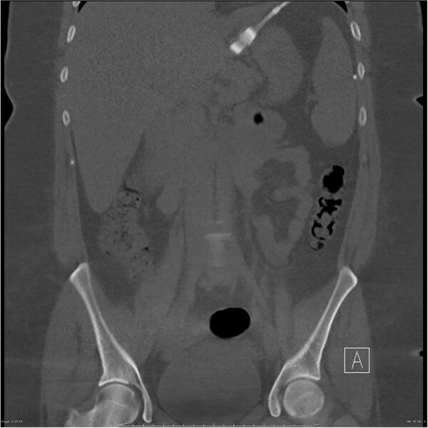 File:Bilateral lumbar ribs (Radiopaedia 25862-26010 Coronal bone window 2).jpg