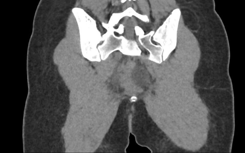 File:Bilateral mature cystic ovarian teratoma (Radiopaedia 88821-105592 Coronal non-contrast 38).jpg