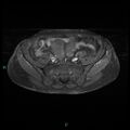 Bilateral ovarian fibroma (Radiopaedia 44568-48293 Axial T1 C+ fat sat 6).jpg