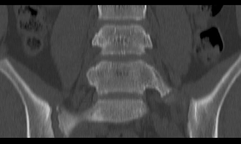 File:Bilateral pars defect (Radiopaedia 26691-26846 Coronal bone window 20).jpg