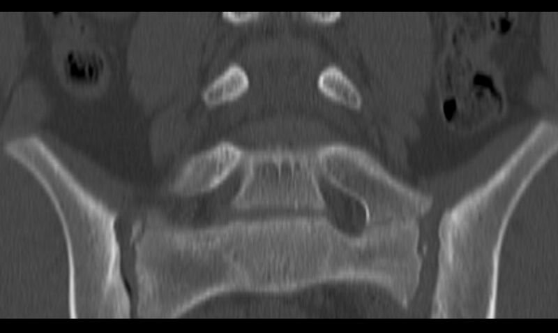 File:Bilateral pars defect (Radiopaedia 26691-26846 Coronal bone window 23).jpg