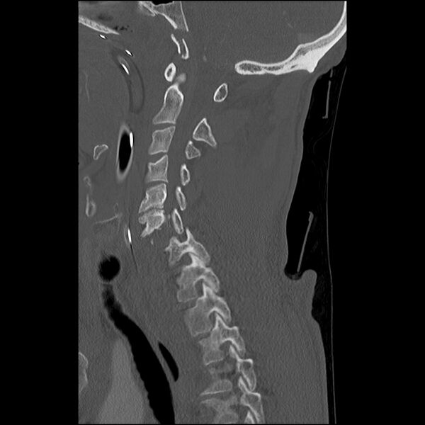 File:Bilateral perched facets with cord injury (Radiopaedia 45587-49713 Sagittal bone window 21).jpg