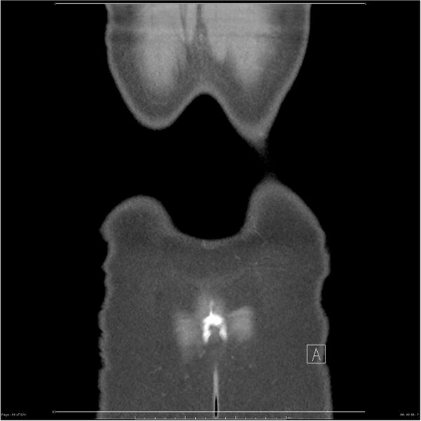 File:Bilateral ureteritis and cystitis (Radiopaedia 25340-25594 B 39).jpg