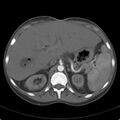 Biliary necrosis - liver transplant (Radiopaedia 21876-21846 A 22).jpg