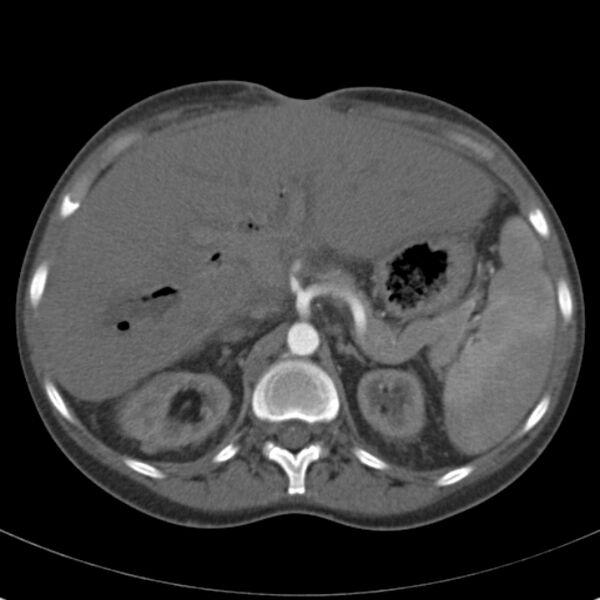 File:Biliary necrosis - liver transplant (Radiopaedia 21876-21846 A 23).jpg