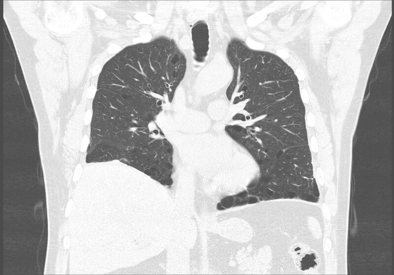 File:Birt-Hogg-Dubé syndrome (Radiopaedia 52578-58491 Coronal lung window 26).jpg