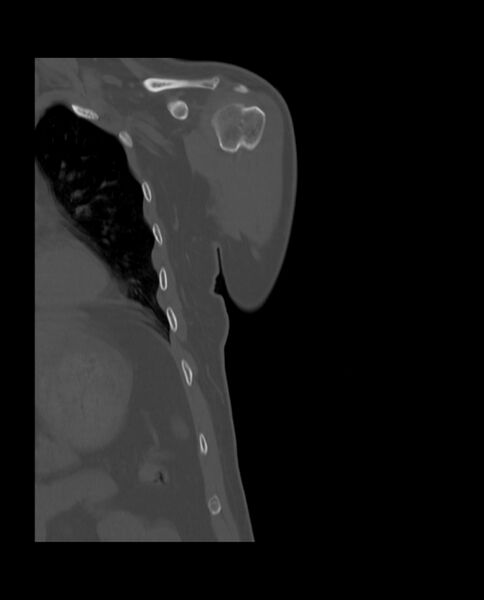 File:Bizarre parosteal osteochondromatous proliferation (Radiopaedia 84221-99501 Coronal bone window 7).jpg