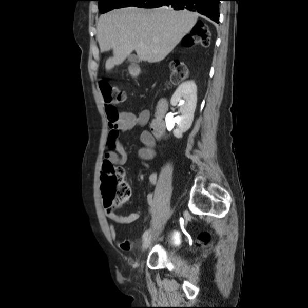 File:Bladder tumor detected on trauma CT (Radiopaedia 51809-57609 E 52).jpg