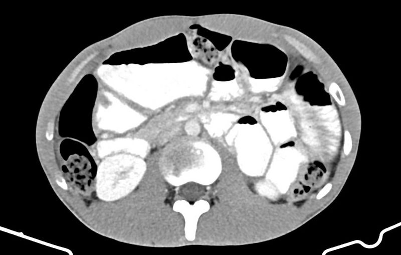 File:Blunt injury to the small bowel (Radiopaedia 74953-85987 A 70).jpg
