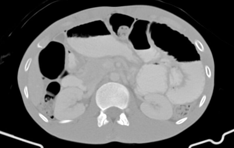 File:Blunt injury to the small bowel (Radiopaedia 74953-85987 Axial Wide 29).jpg