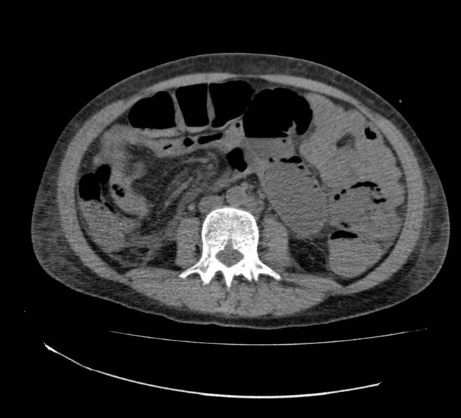 File:Bowel lymphoma complicated by bleeding after therapy (Radiopaedia 55601-62110 Axial non-contrast 43).jpg