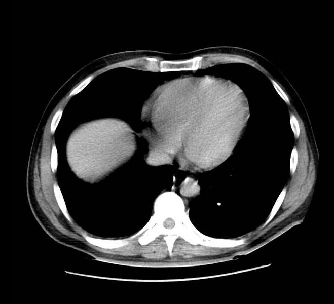 File:Bowel obstruction from colon carcinoma (Radiopaedia 22995-23028 A 4).jpg