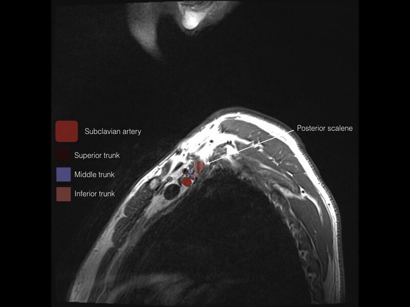 File:Brachial plexus anatomy (Radiopaedia 64414-73227 Sagittal T1 12).jpeg