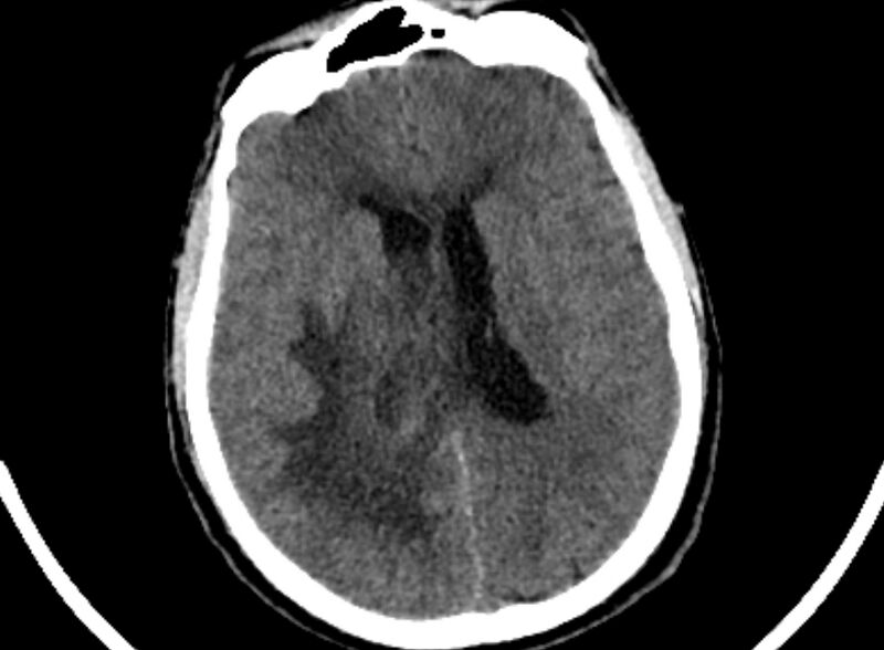File:Brain abscess complicated by intraventricular rupture and ventriculitis (Radiopaedia 82434-96575 Axial non-contrast 57).jpg