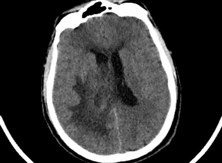 Brain abscess complicated by intraventricular rupture and ventriculitis (Radiopaedia 82434-96575 Axial non-contrast 57).jpg