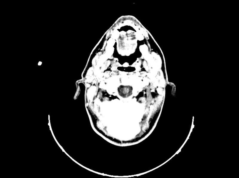 File:Brain injury by firearm projectile (Radiopaedia 82068-96088 B 55).jpg