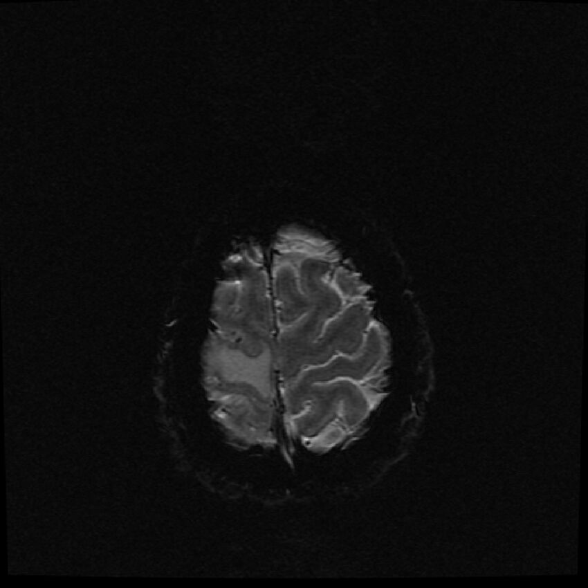 Brain metastases (renal cell carcinoma) (Radiopaedia 42571-45704 Axial SWI 1).jpg
