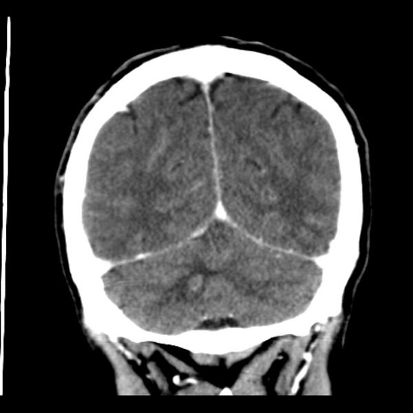 File:Brain metastases from lung cancer (Radiopaedia 24480-24781 Coronal C+ delayed 50).jpg