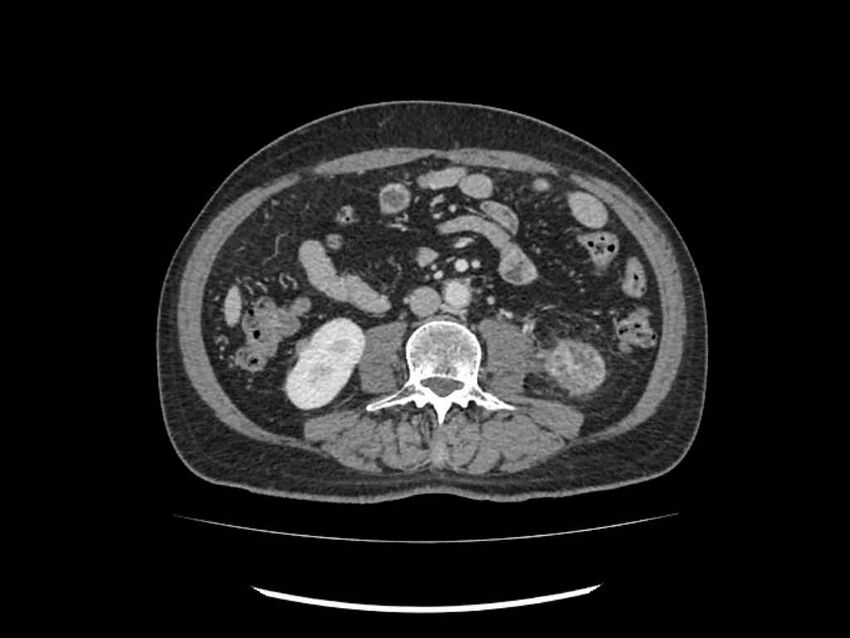 Brain metastases from renal cell carcinoma (Radiopaedia 42222-45328 B 152).jpg