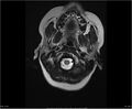 Brainstem glioma (Radiopaedia 21819-21775 Axial T2 3).jpg