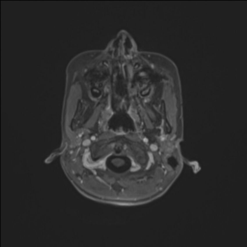Brainstem glioma (Radiopaedia 70548-80674 Axial T1 C+ 15).jpg